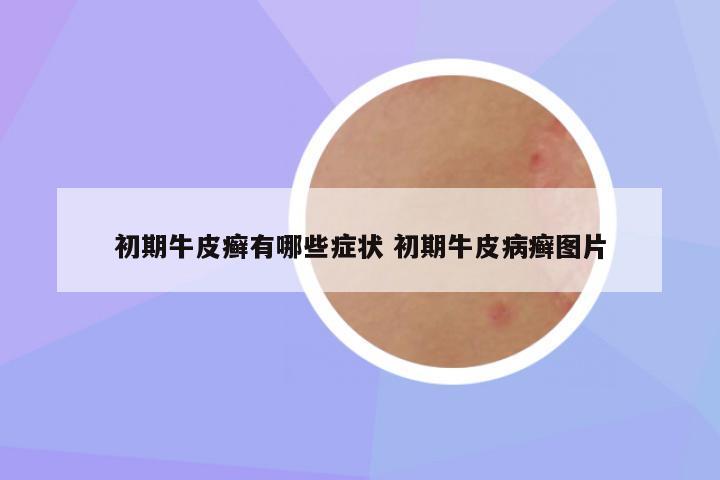 初期牛皮癣有哪些症状 初期牛皮病癣图片