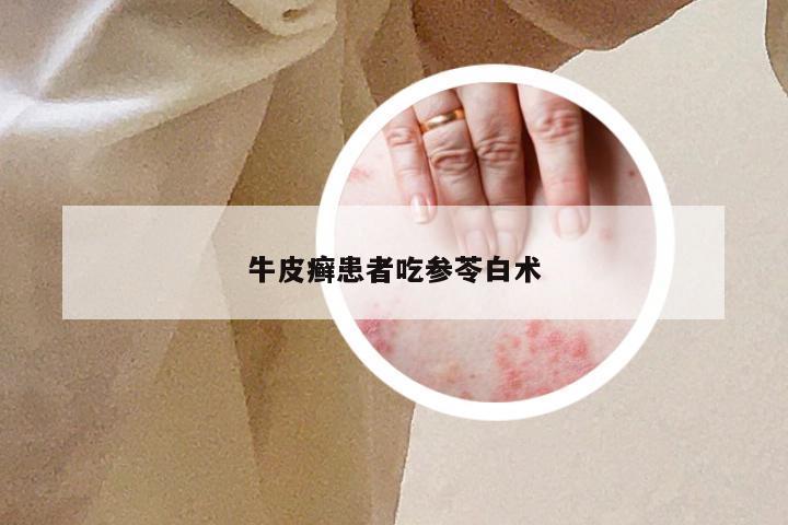 牛皮癣患者吃参苓白术
