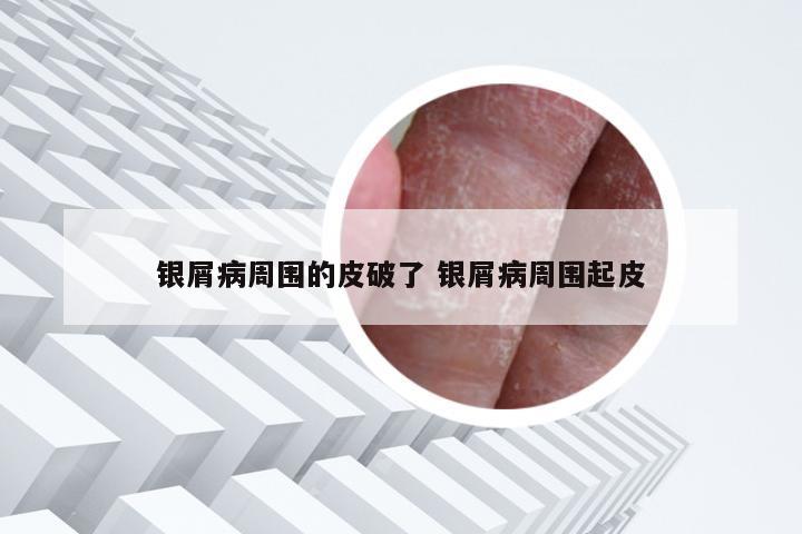 银屑病周围的皮破了 银屑病周围起皮