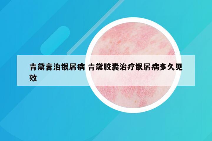 青黛膏治银屑病 青黛胶囊治疗银屑病多久见效