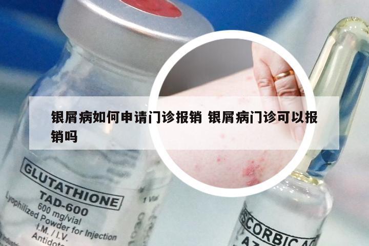 银屑病如何申请门诊报销 银屑病门诊可以报销吗
