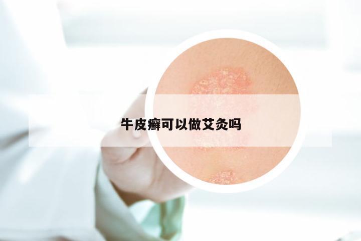 牛皮癣可以做艾灸吗