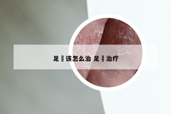 足廯该怎么治 足廯治疗