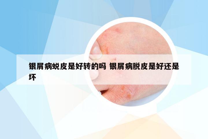银屑病蜕皮是好转的吗 银屑病脱皮是好还是坏
