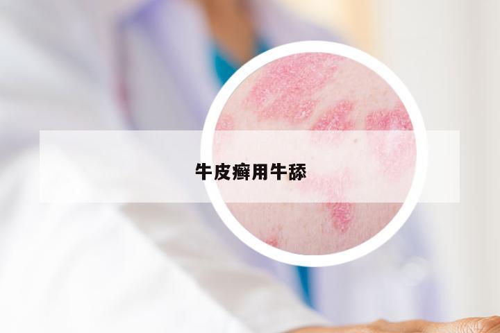 牛皮癣用牛舔