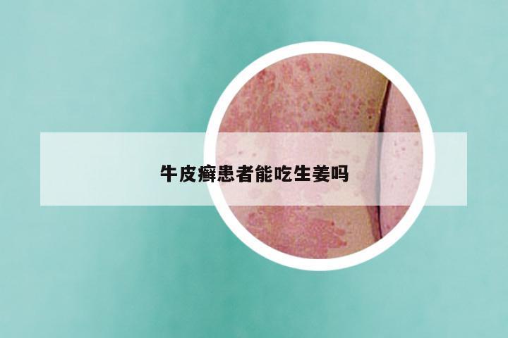 牛皮癣患者能吃生姜吗