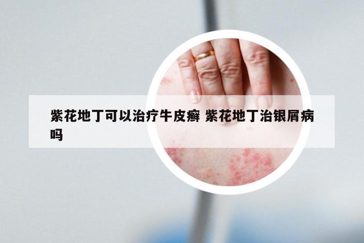 紫花地丁可以治疗牛皮癣 紫花地丁治银屑病吗