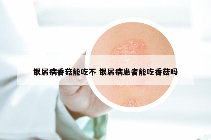 银屑病香菇能吃不 银屑病患者能吃香菇吗