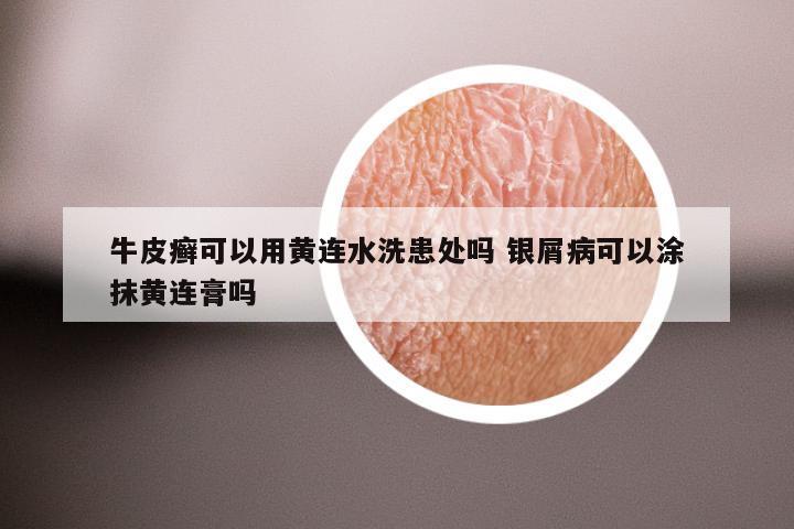 牛皮癣可以用黄连水洗患处吗 银屑病可以涂抹黄连膏吗