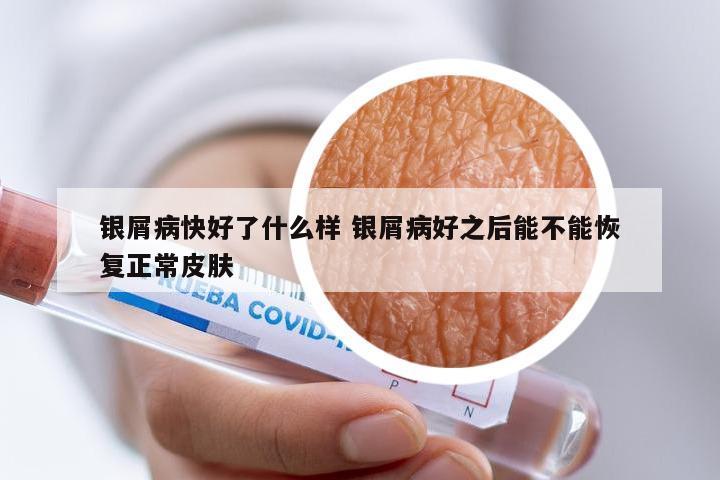 银屑病快好了什么样 银屑病好之后能不能恢复正常皮肤