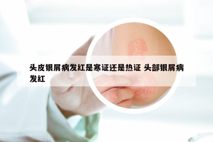 头皮银屑病发红是寒证还是热证 头部银屑病发红
