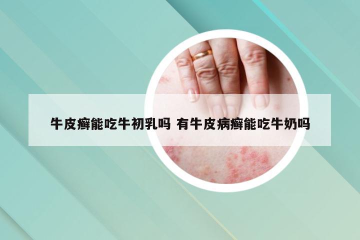 牛皮癣能吃牛初乳吗 有牛皮病癣能吃牛奶吗