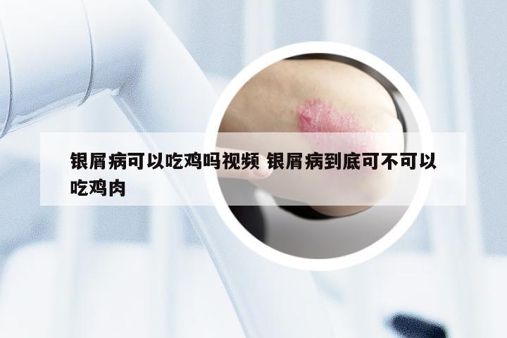 银屑病可以吃鸡吗视频 银屑病到底可不可以吃鸡肉
