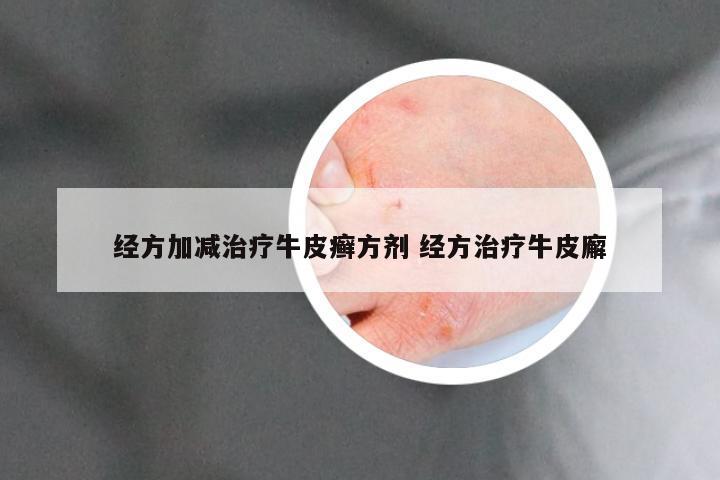 经方加减治疗牛皮癣方剂 经方治疗牛皮廨