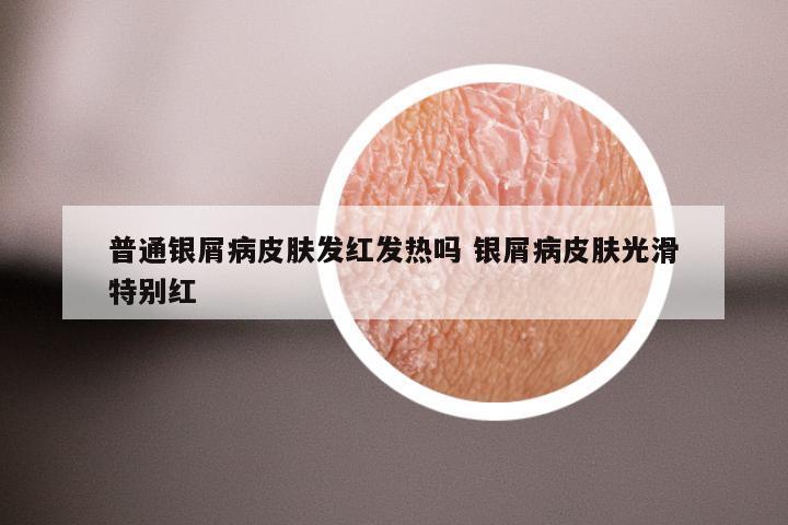 普通银屑病皮肤发红发热吗 银屑病皮肤光滑特别红
