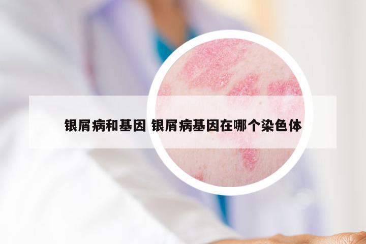 银屑病和基因 银屑病基因在哪个染色体
