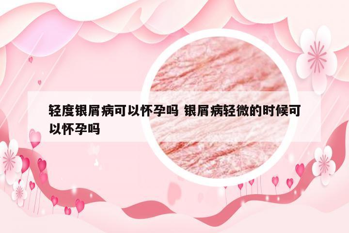 轻度银屑病可以怀孕吗 银屑病轻微的时候可以怀孕吗