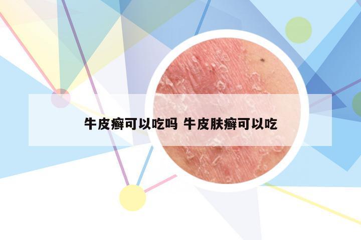 牛皮癣可以吃吗 牛皮肤癣可以吃