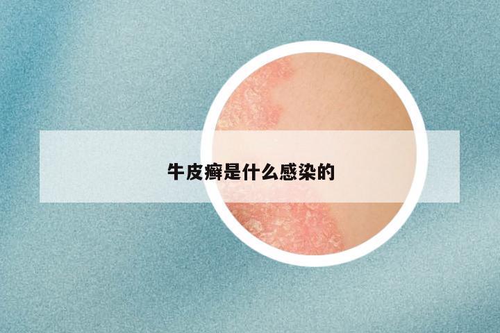 牛皮癣是什么感染的