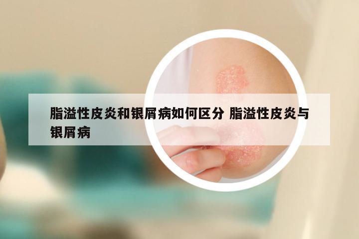 脂溢性皮炎和银屑病如何区分 脂溢性皮炎与银屑病
