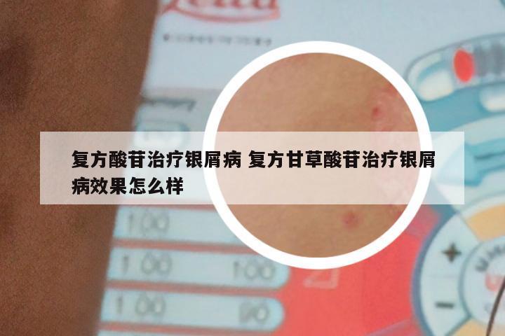 复方酸苷治疗银屑病 复方甘草酸苷治疗银屑病效果怎么样