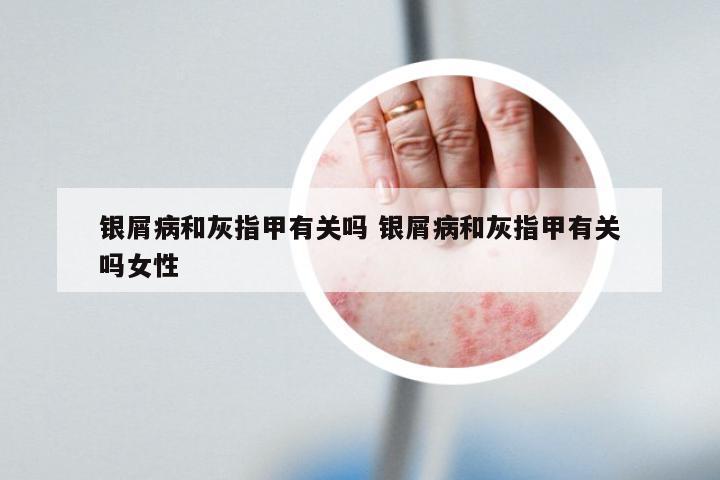 银屑病和灰指甲有关吗 银屑病和灰指甲有关吗女性