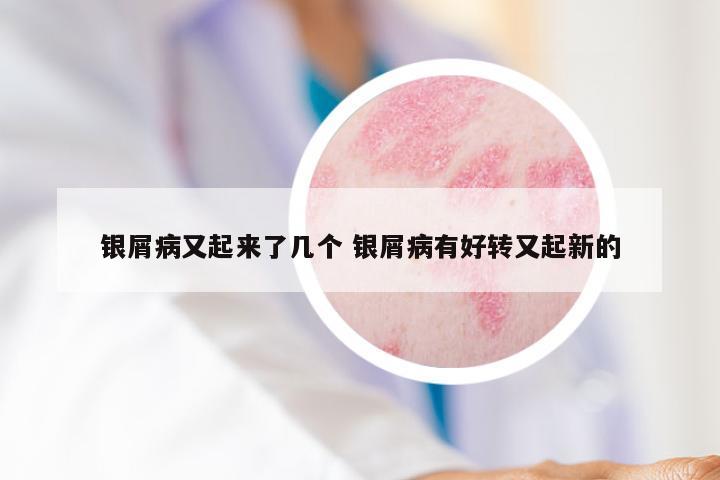 银屑病又起来了几个 银屑病有好转又起新的