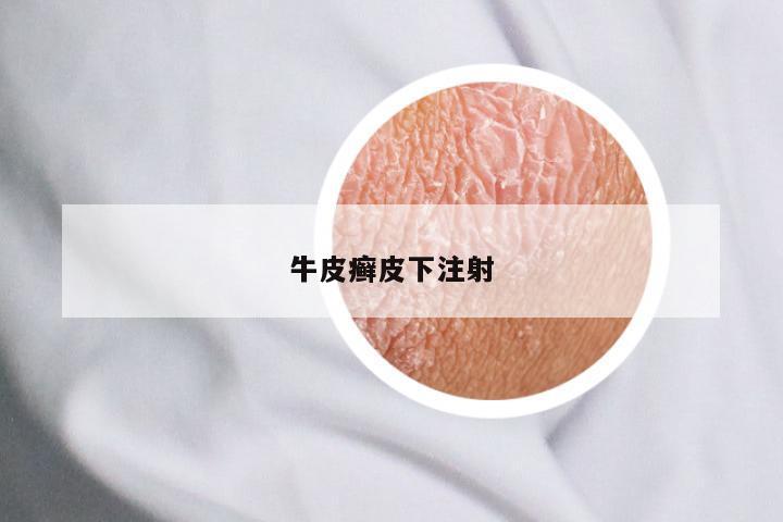 牛皮癣皮下注射