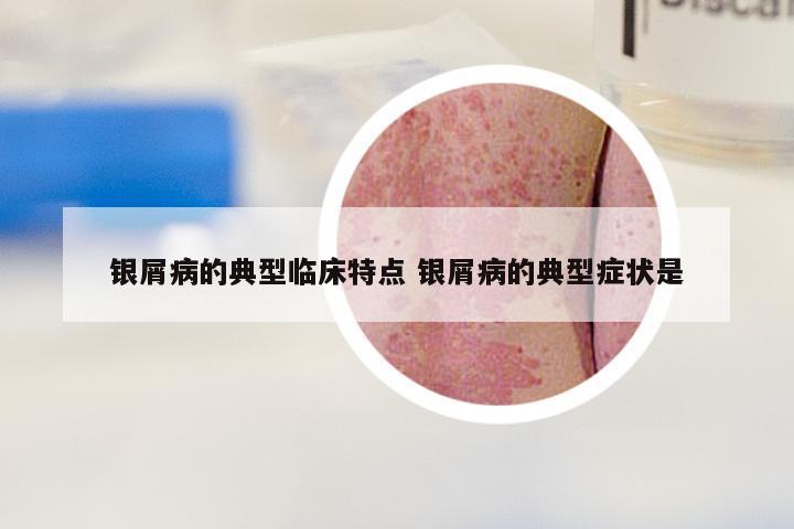 银屑病的典型临床特点 银屑病的典型症状是