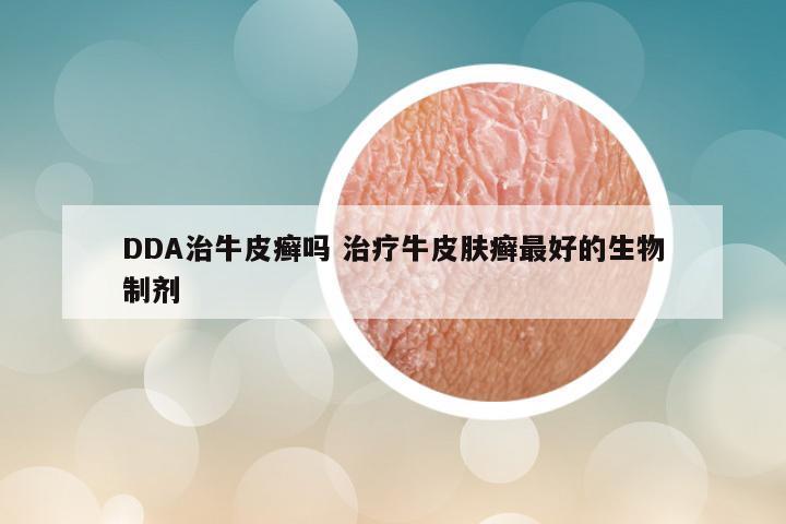 DDA治牛皮癣吗 治疗牛皮肤癣最好的生物制剂