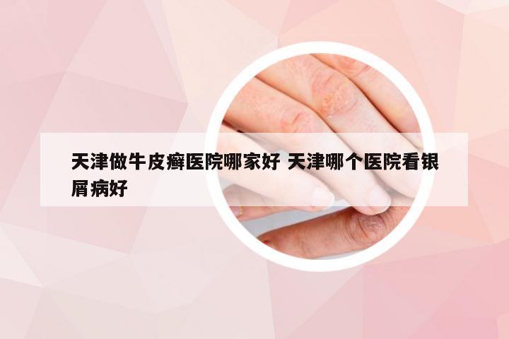 天津做牛皮癣医院哪家好 天津哪个医院看银屑病好