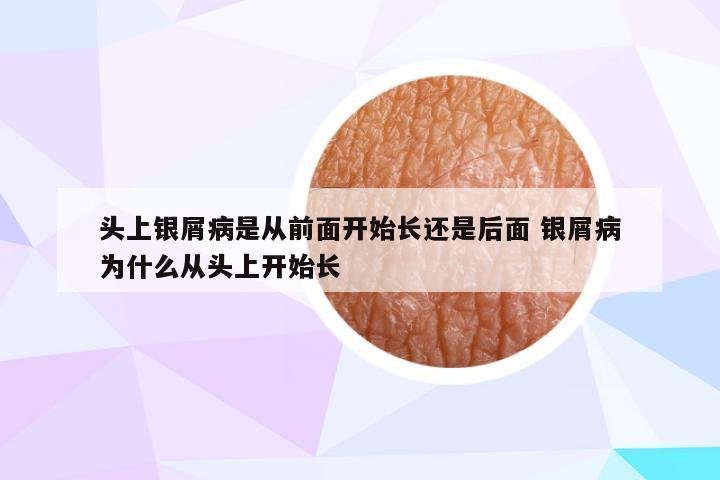 头上银屑病是从前面开始长还是后面 银屑病为什么从头上开始长