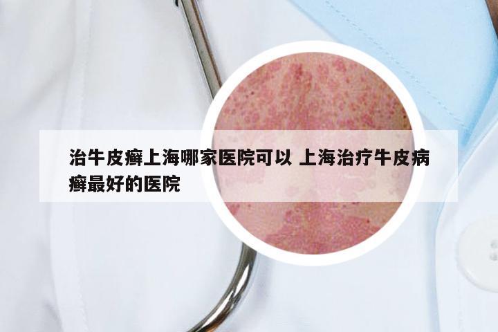治牛皮癣上海哪家医院可以 上海治疗牛皮病癣最好的医院