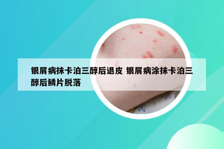 银屑病抹卡泊三醇后退皮 银屑病涂抹卡泊三醇后鳞片脱落