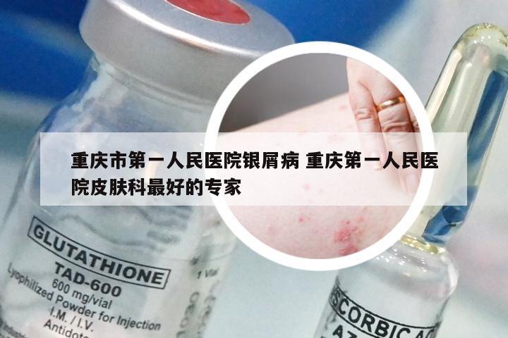 重庆市第一人民医院银屑病 重庆第一人民医院皮肤科最好的专家