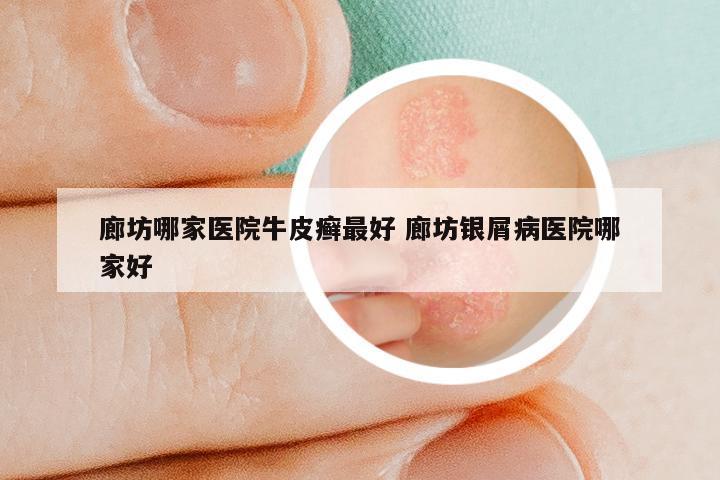廊坊哪家医院牛皮癣最好 廊坊银屑病医院哪家好