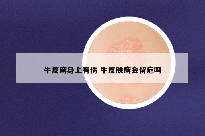 牛皮癣身上有伤 牛皮肤癣会留疤吗