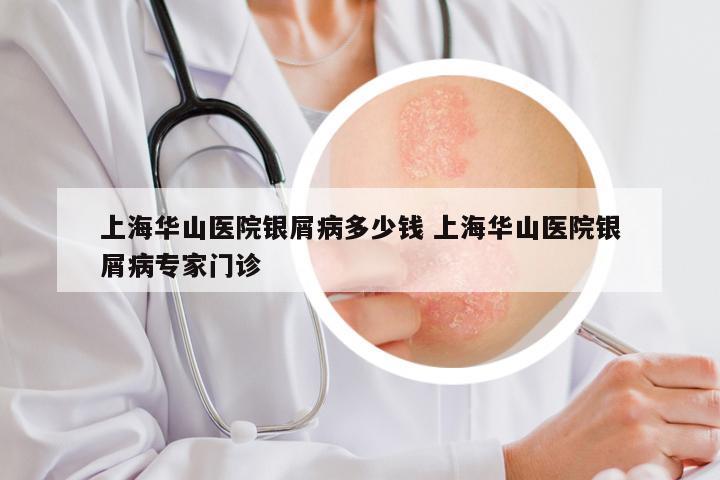 上海华山医院银屑病多少钱 上海华山医院银屑病专家门诊