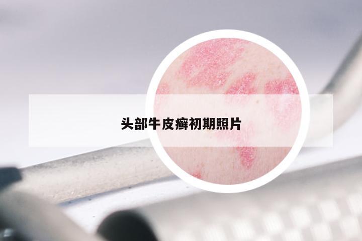 头部牛皮癣初期照片
