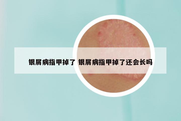 银屑病指甲掉了 银屑病指甲掉了还会长吗