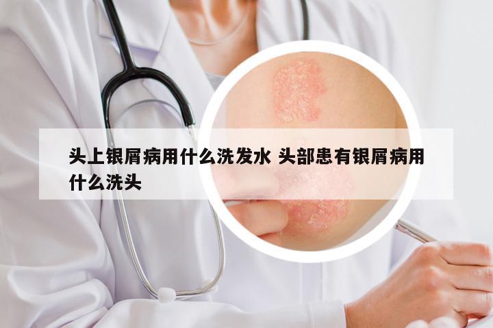头上银屑病用什么洗发水 头部患有银屑病用什么洗头