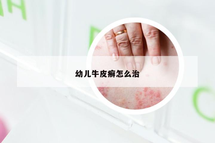 幼儿牛皮癣怎么治