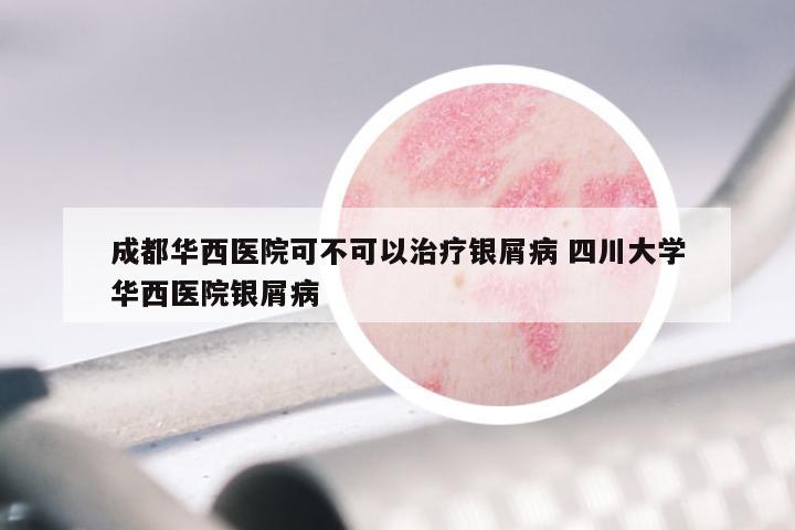 成都华西医院可不可以治疗银屑病 四川大学华西医院银屑病