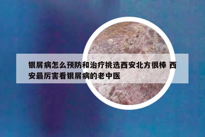 银屑病怎么预防和治疗挑选西安北方很棒 西安最厉害看银屑病的老中医