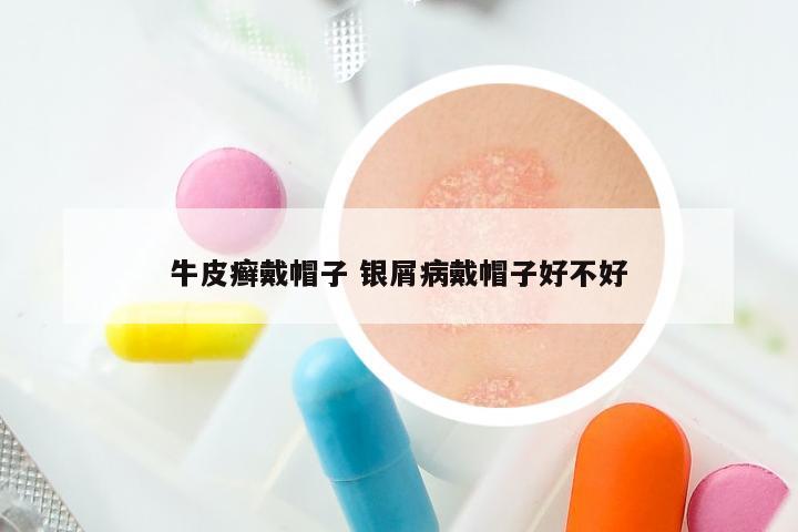 牛皮癣戴帽子 银屑病戴帽子好不好