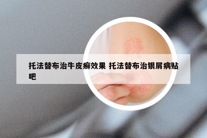 托法替布治牛皮癣效果 托法替布治银屑病贴吧