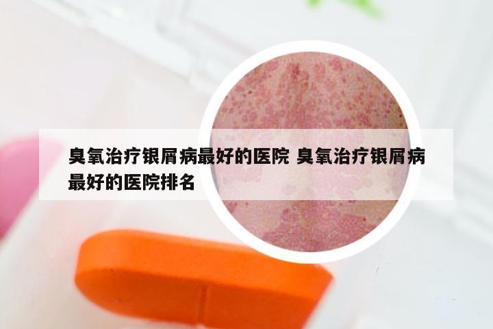 臭氧治疗银屑病最好的医院 臭氧治疗银屑病最好的医院排名