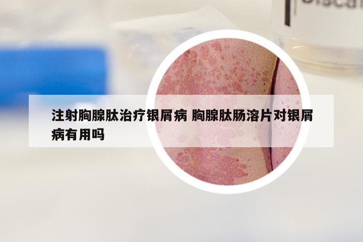 注射胸腺肽治疗银屑病 胸腺肽肠溶片对银屑病有用吗
