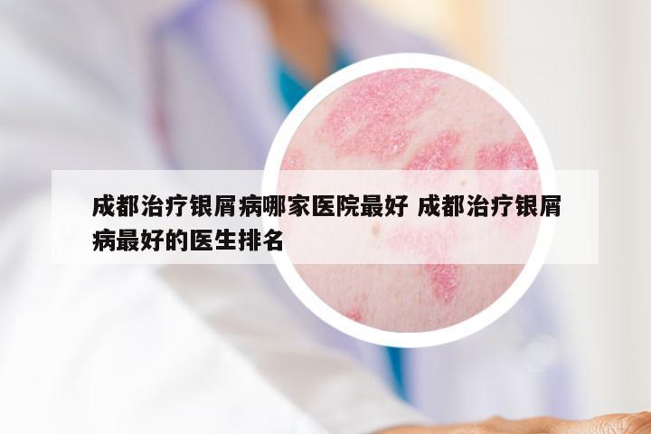 成都治疗银屑病哪家医院最好 成都治疗银屑病最好的医生排名