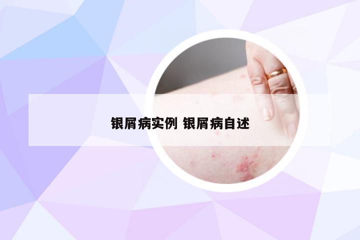 银屑病实例 银屑病自述